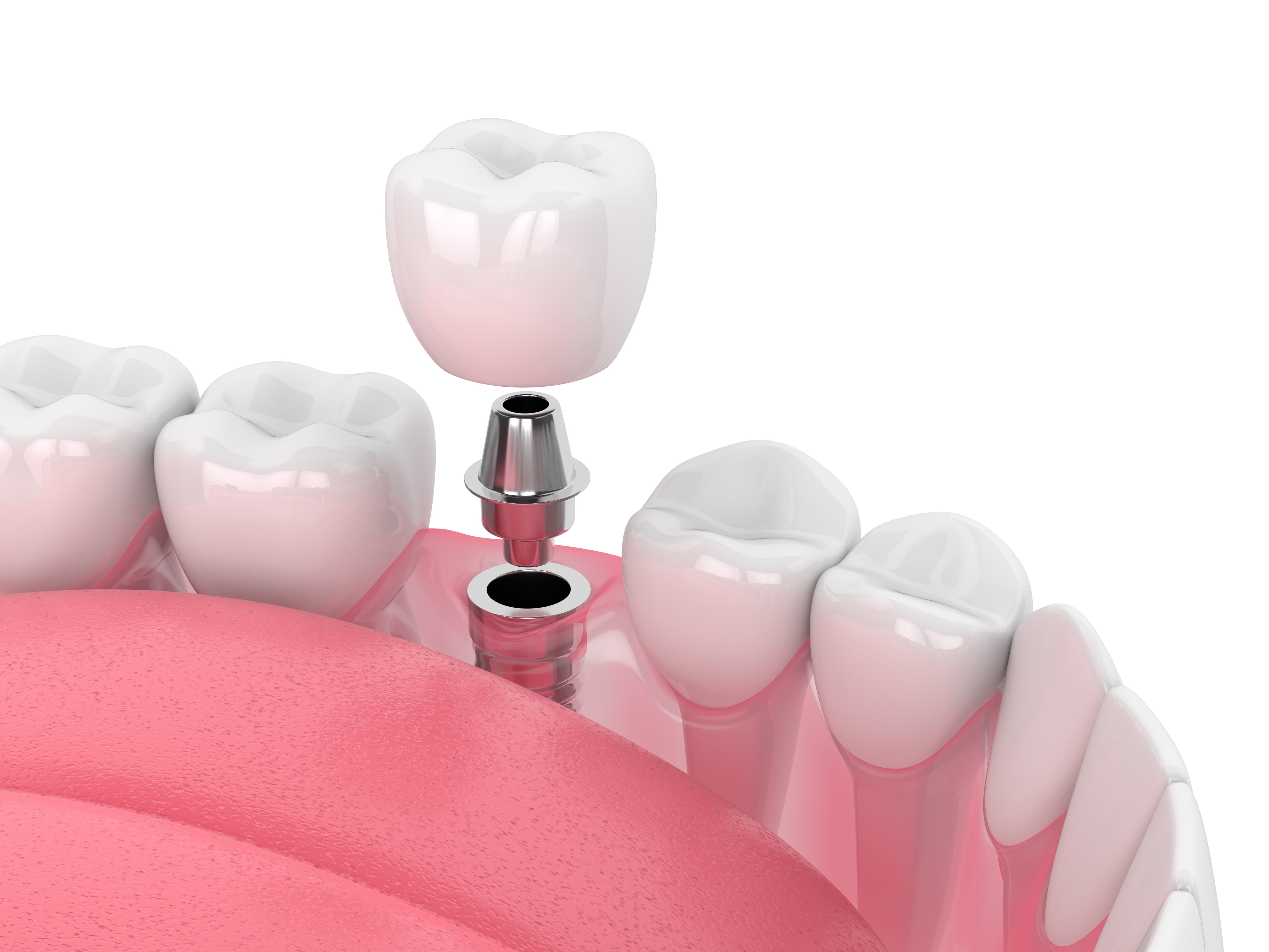 Implants