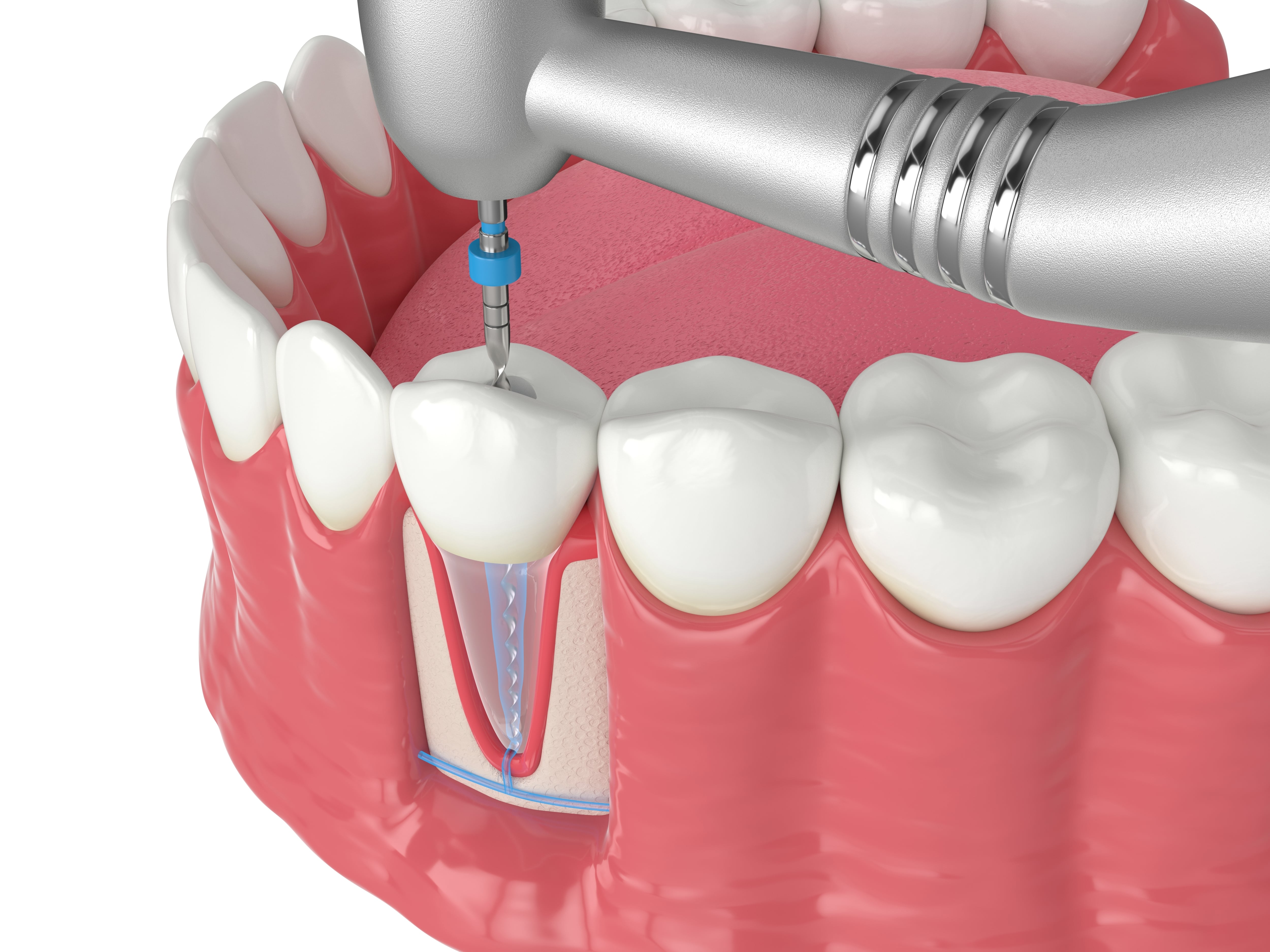 Root canals
