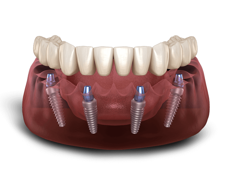 Full Arch of Implants